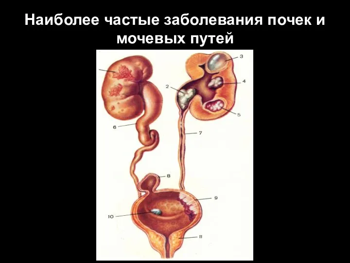 Наиболее частые заболевания почек и мочевых путей