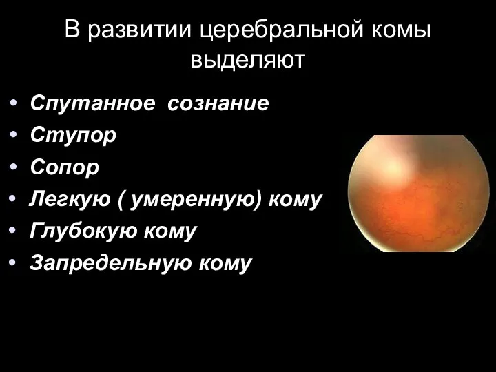 В развитии церебральной комы выделяют Спутанное сознание Ступор Сопор Легкую ( умеренную)