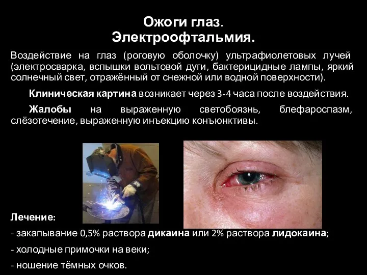Ожоги глаз. Электроофтальмия. Воздействие на глаз (роговую оболочку) ультрафиолетовых лучей (электросварка, вспышки
