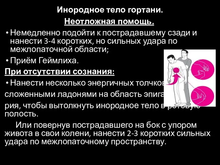 Инородное тело гортани. Неотложная помощь. Немедленно подойти к пострадавшему сзади и нанести