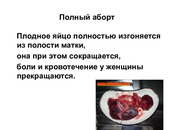 Полный аборт Плодное яйцо полностью изгоняется из полости матки, она при этом