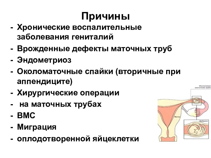 Причины Хронические воспалительные заболевания гениталий Врожденные дефекты маточных труб Эндометриоз Околоматочные спайки