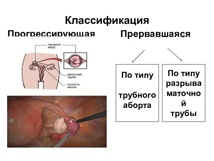 Классификация Прогрессирующая Прервавшаяся По типу трубного аборта По типу разрыва маточной трубы