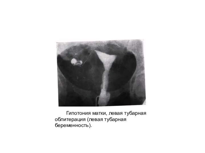 Гипотония матки, левая тубарная облитерация (левая тубарная беременность).