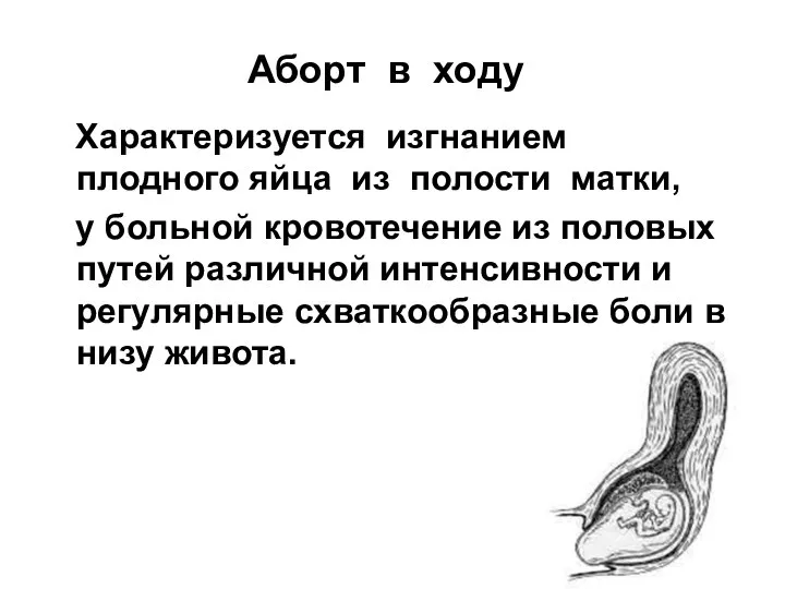 Аборт в ходу Характеризуется изгнанием плодного яйца из полости матки, у больной