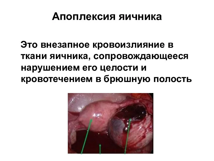 Апоплексия яичника Это внезапное кровоизлияние в ткани яичника, сопровождающееся нарушением его целости