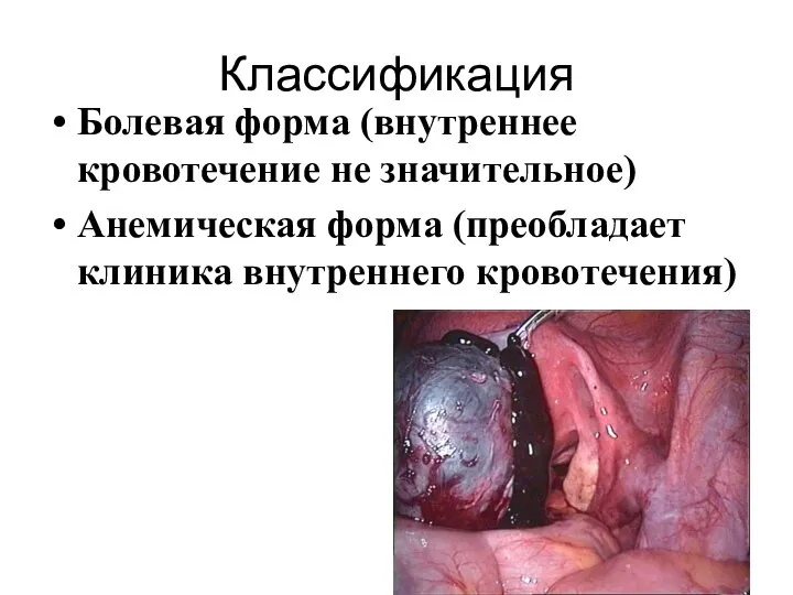 Классификация Болевая форма (внутреннее кровотечение не значительное) Анемическая форма (преобладает клиника внутреннего кровотечения)