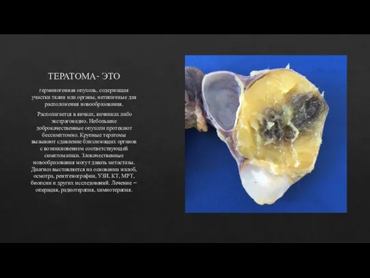ТЕРАТОМА- ЭТО герминогенная опухоль, содержащая участки ткани или органы, нетипичные для расположения