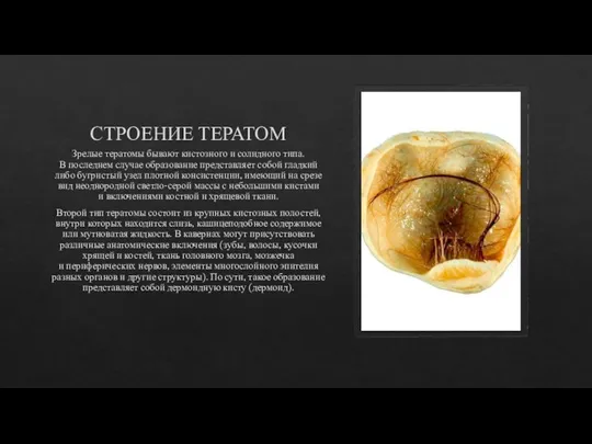 СТРОЕНИЕ ТЕРАТОМ Зрелые тератомы бывают кистозного и солидного типа. В последнем случае