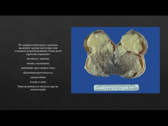 По морфологическому строению выделяют зрелые кистозные или солидные новообразования. Чаще всего тератомы