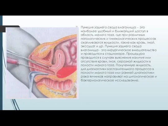 Пункция заднего свода влагалища -- это наиболее удобный и ближайший доступ в