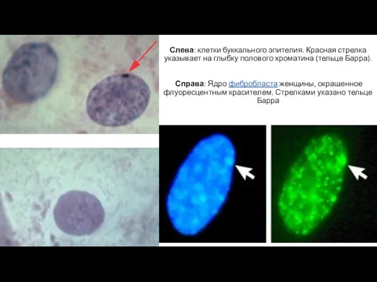 Слева: клетки буккального эпителия. Красная стрелка указывает на глыбку полового хроматина (тельце