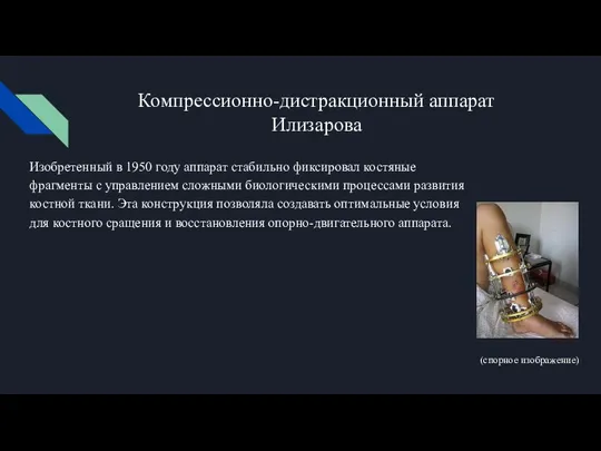 Компрессионно-дистракционный аппарат Илизарова Изобретенный в 1950 году аппарат стабильно фиксировал костяные фрагменты