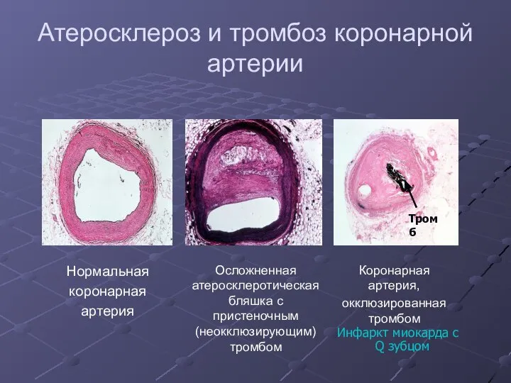 Атеросклероз и тромбоз коронарной артерии Коронарная артерия, окклюзированная тромбом Осложненная атеросклеротическая бляшка