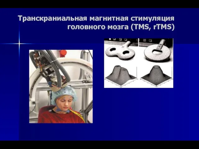 Транскраниальная магнитная стимуляция головного мозга (TMS, rTMS)