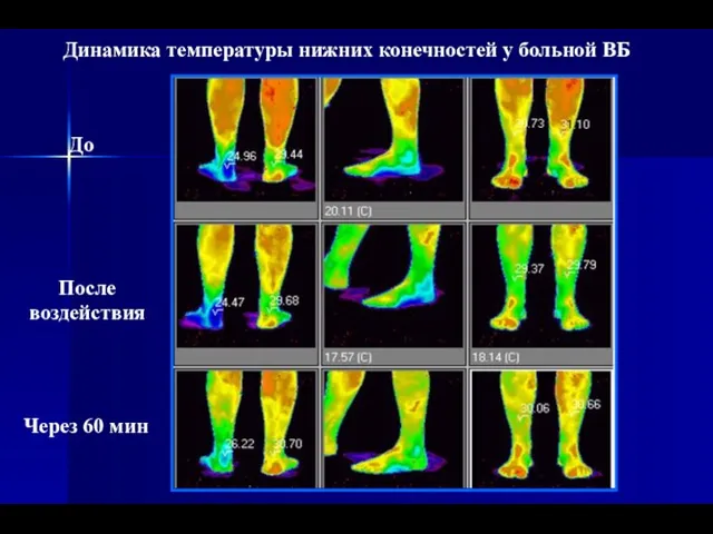 Динамика температуры нижних конечностей у больной ВБ До После воздействия Через 60 мин