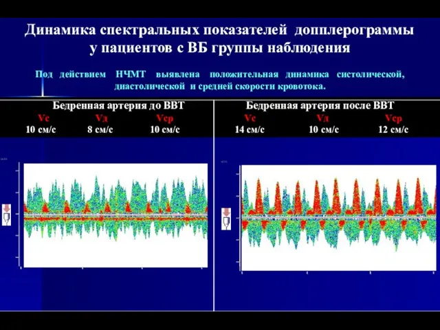 Динамика спектральных показателей допплерограммы у пациентов с ВБ группы наблюдения Под действием