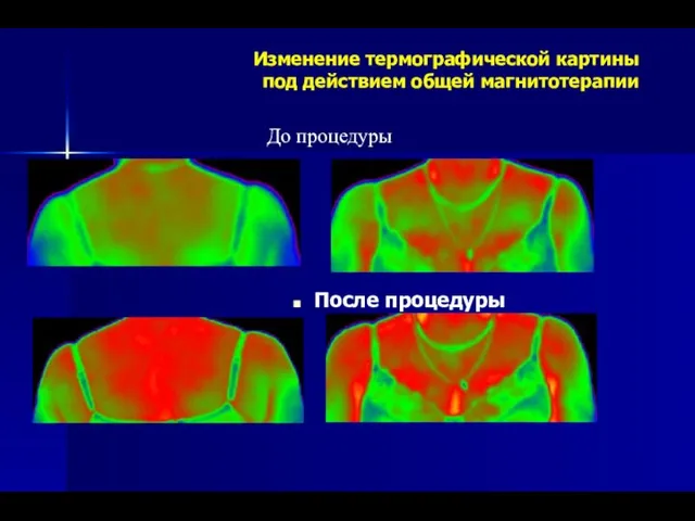 Изменение термографической картины под действием общей магнитотерапии После процедуры До процедуры