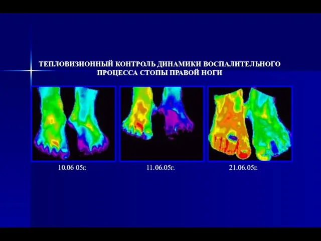ТЕПЛОВИЗИОННЫЙ КОНТРОЛЬ ДИНАМИКИ ВОСПАЛИТЕЛЬНОГО ПРОЦЕССА СТОПЫ ПРАВОЙ НОГИ 10.06 05г. 11.06.05г. 21.06.05г.
