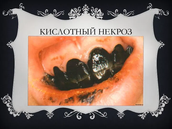 КИСЛОТНЫЙ НЕКРОЗ