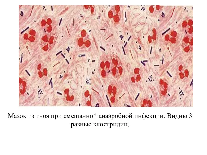 Мазок из гноя при смешанной анаэробной инфекции. Видны 3 разные клостридии.