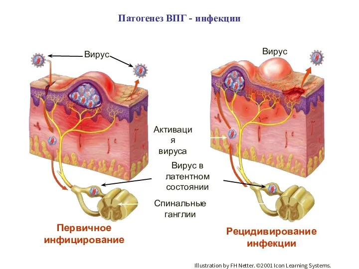 Вирус Спинальные ганглии Вирус в латентном состоянии Активация вируса Первичное инфицирование Рецидивирование