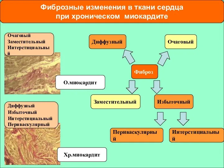 Фиброзные изменения в ткани сердца при хроническом миокардите Очаговый Заместительный Интерстициальный Диффузный