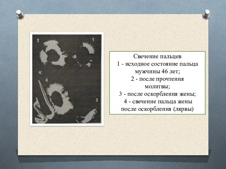 Свечение пальцев 1 - исходное состояние пальца мужчины 46 лет; 2 -