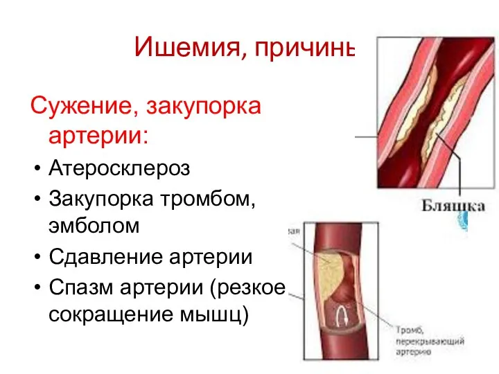 Ишемия, причины Сужение, закупорка артерии: Атеросклероз Закупорка тромбом, эмболом Сдавление артерии Спазм артерии (резкое сокращение мышц)