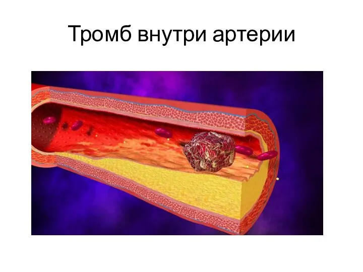 Тромб внутри артерии
