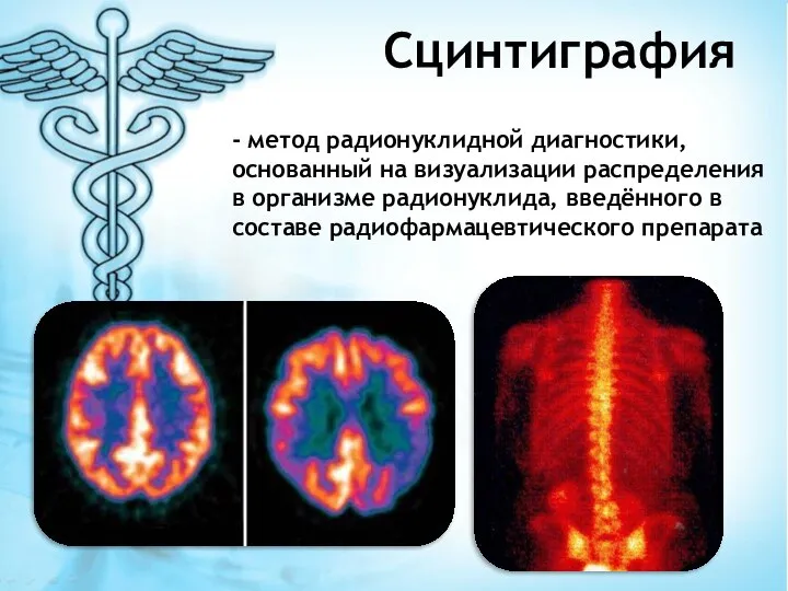 Сцинтиграфия - метод радионуклидной диагностики, основанный на визуализации распределения в организме радионуклида,