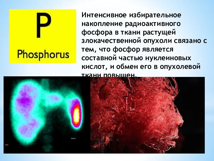 Интенсивное избирательное накопление радиоактивного фосфора в ткани растущей злокачественной опухоли связано с