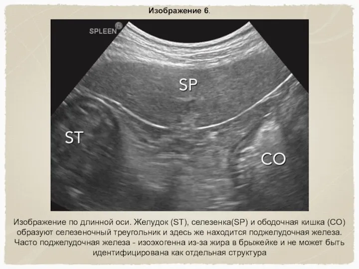 Изображение 6. Изображение по длинной оси. Желудок (ST), селезенка(SP) и ободочная кишка