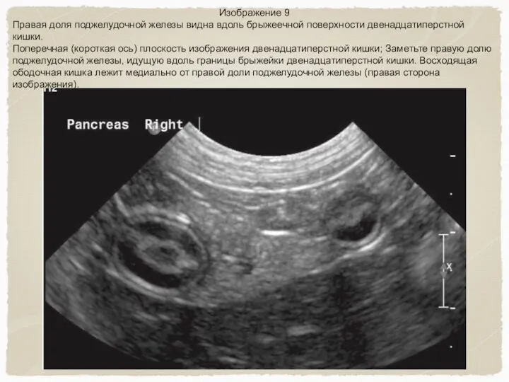 Изображение 9 Правая доля поджелудочной железы видна вдоль брыжеечной поверхности двенадцатиперстной кишки.
