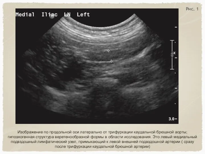 Изображение по продольной оси латерально от трифуркации каудальной брюшной аорты; гипоэхогенная структура