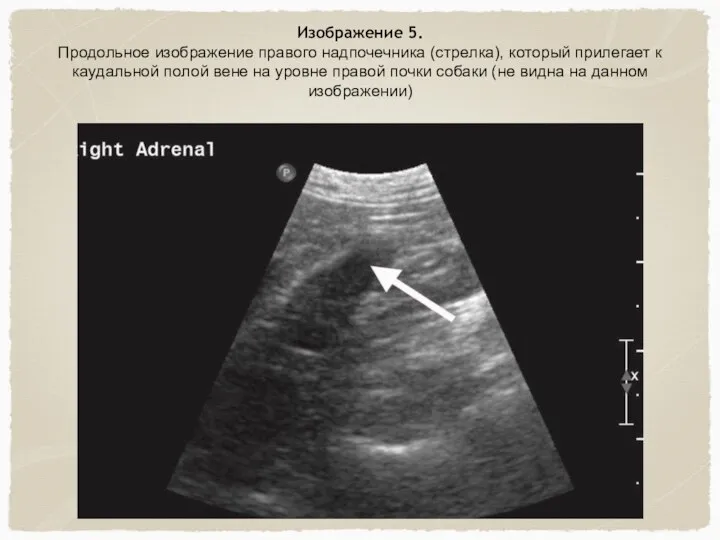Изображение 5. Продольное изображение правого надпочечника (стрелка), который прилегает к каудальной полой