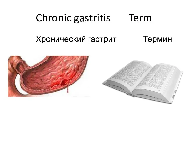 Chronic gastritis Term Хронический гастрит Термин