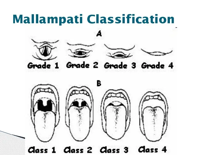 Mallampati Classification