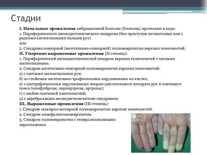 Стадии I. Начальные проявления вибрационной болезни (Iстепень) протекают в виде: 1. Периферического