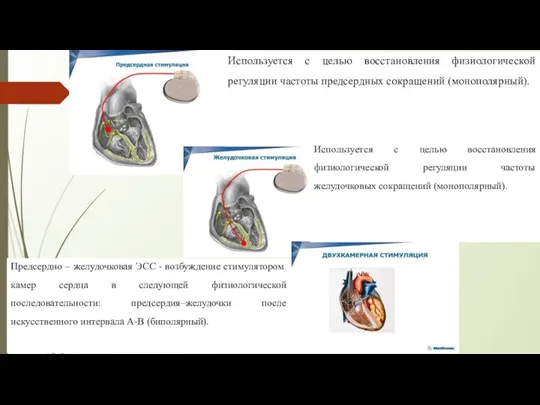 Используется с целью восстановления физиологической регуляции частоты предсердных сокращений (монополярный). Используется с