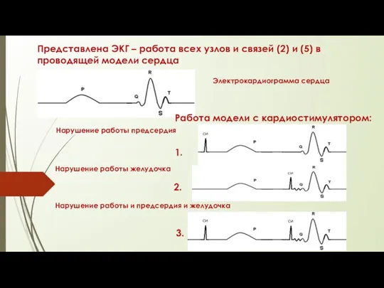 Представлена ЭКГ – работа всех узлов и связей (2) и (5) в