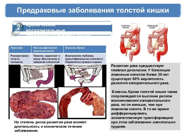 Предраковые заболевания толстой кишки 2 Хронические воспалительные заболевания толстой кишки Развитию рака