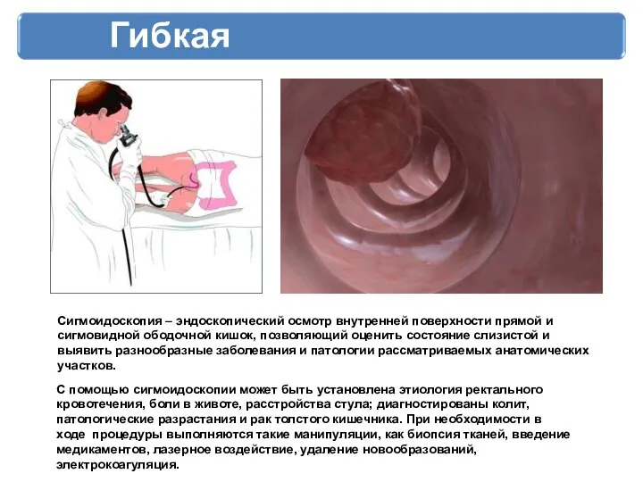 Гибкая сигмоидоскопия Сигмоидоскопия – эндоскопический осмотр внутренней поверхности прямой и сигмовидной ободочной