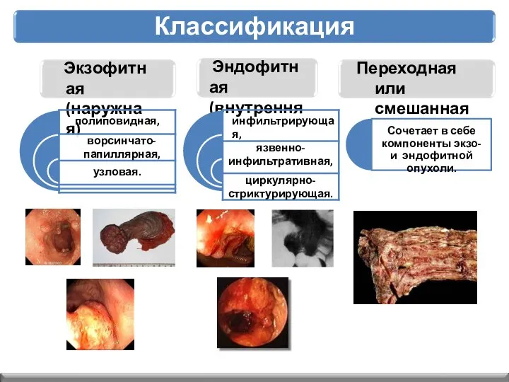 Экзофитная (наружная) Эндофитная (внутренняя) Переходная или смешанная Сочетает в себе компоненты экзо- и эндофитной опухоли. Классификация