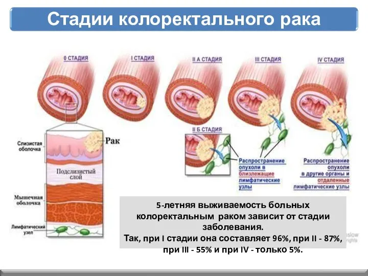 5-летняя выживаемость больных колоректальным раком зависит от стадии заболевания. Так, при I