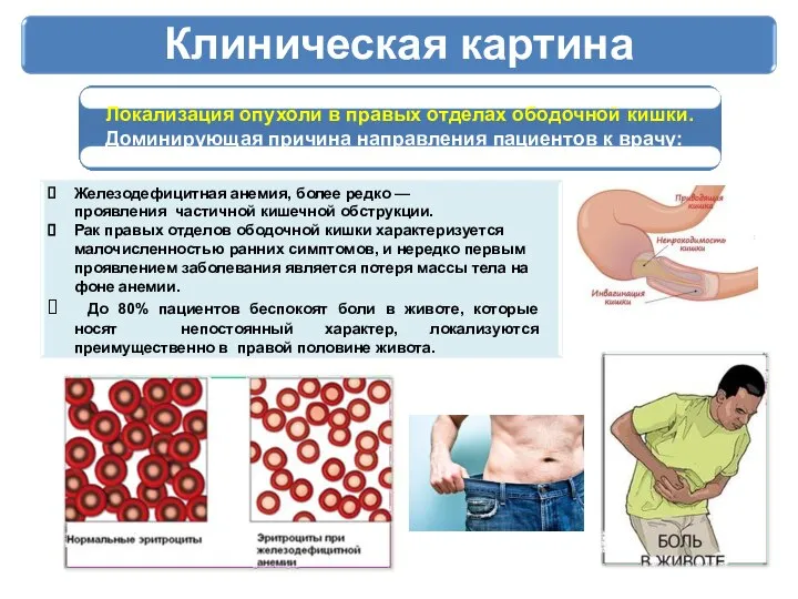 Клиническая картина Локализация опухоли в правых отделах ободочной кишки. Доминирующая причина направления