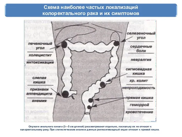 Схема наиболее частых локализаций колоректального рака и их симптомов Опухоли анального канала