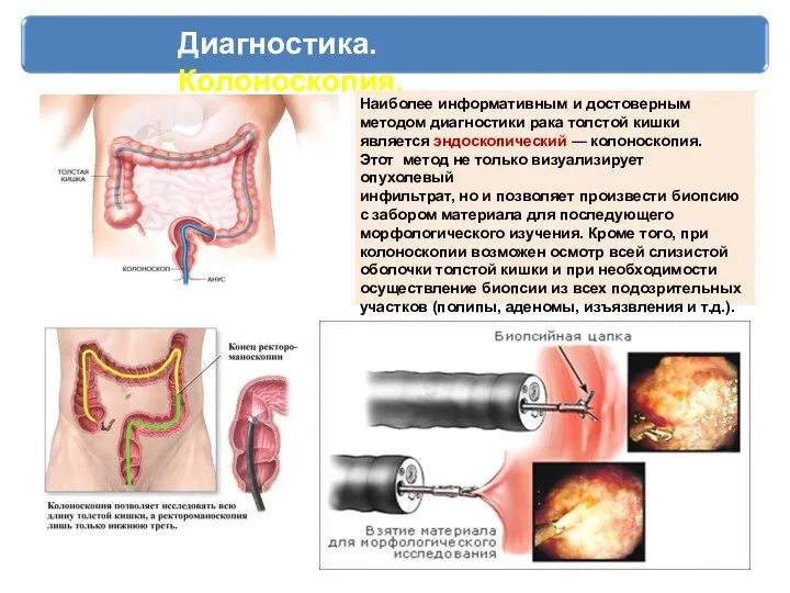 Диагностика. Колоноскопия. Наиболее информативным и достоверным методом диагностики рака толстой кишки является