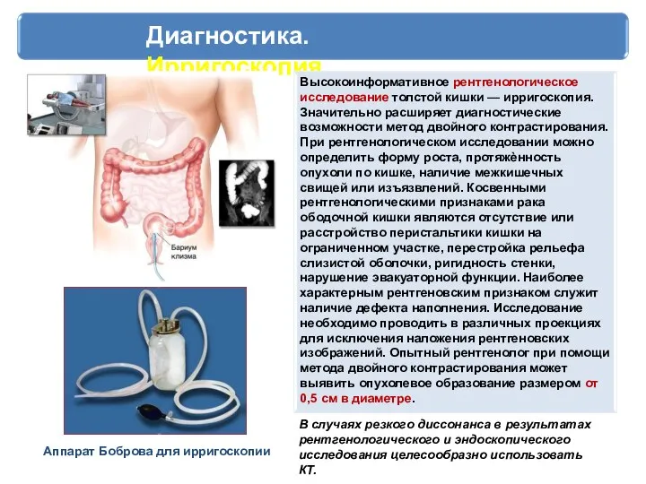 Диагностика. Ирригоскопия. Высокоинформативное рентгенологическое исследование толстой кишки — ирригоскопия. Значительно расширяет диагностические