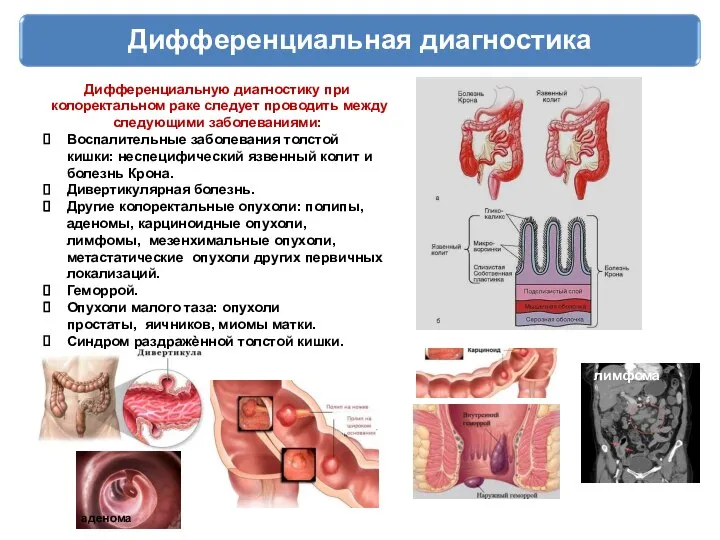 Дифференциальная диагностика Дифференциальную диагностику при колоректальном раке следует проводить между следующими заболеваниями: